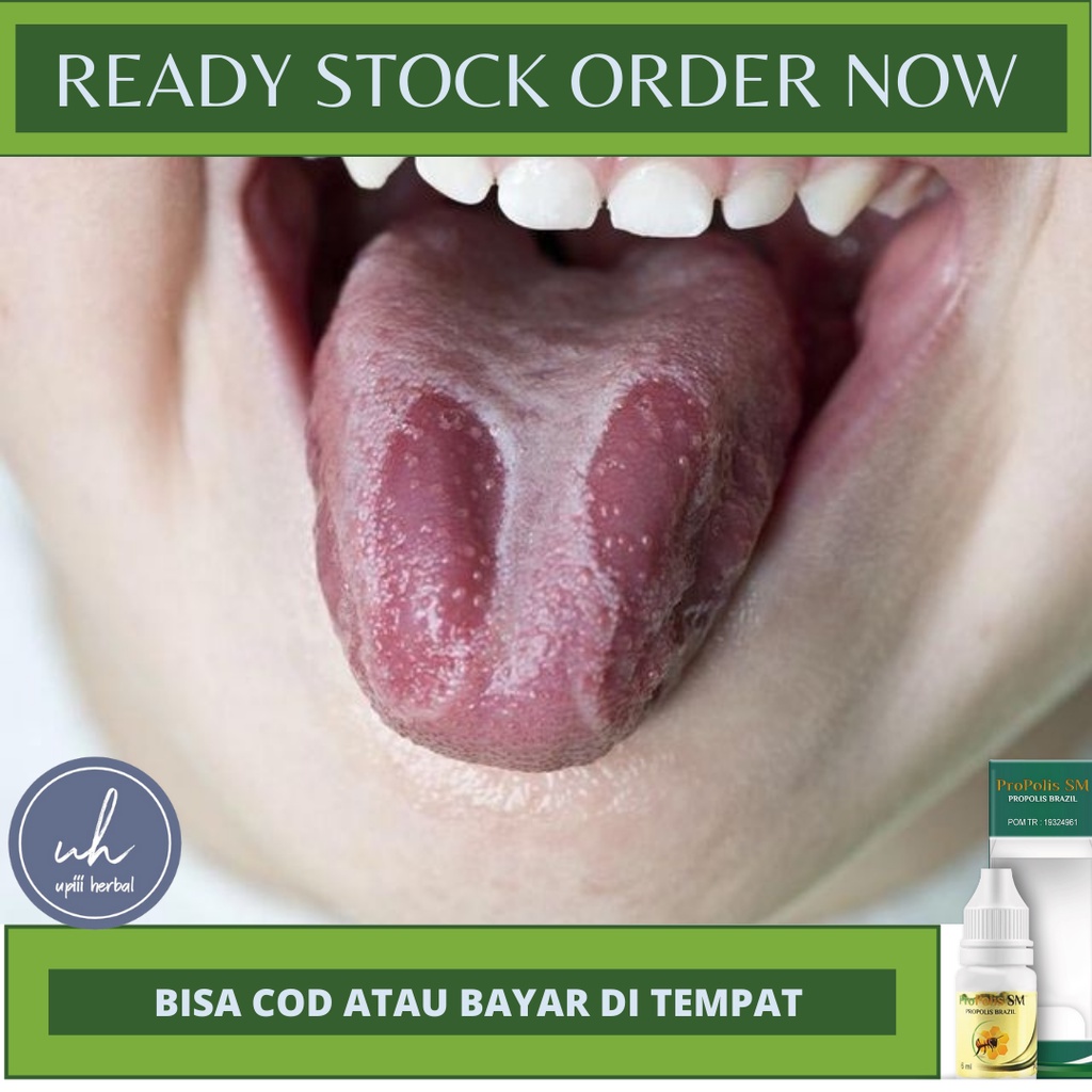 Jual Obat Candidiasis 100 Original Sudah Bpom And Halal Mui Obat Herbal Candidiasis Pada 9245