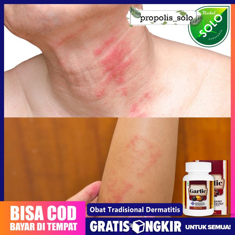 Obat Dermatitis - Obat Dermatitis Seboroik Paling Aman Dengan Black Garlic Kapsul