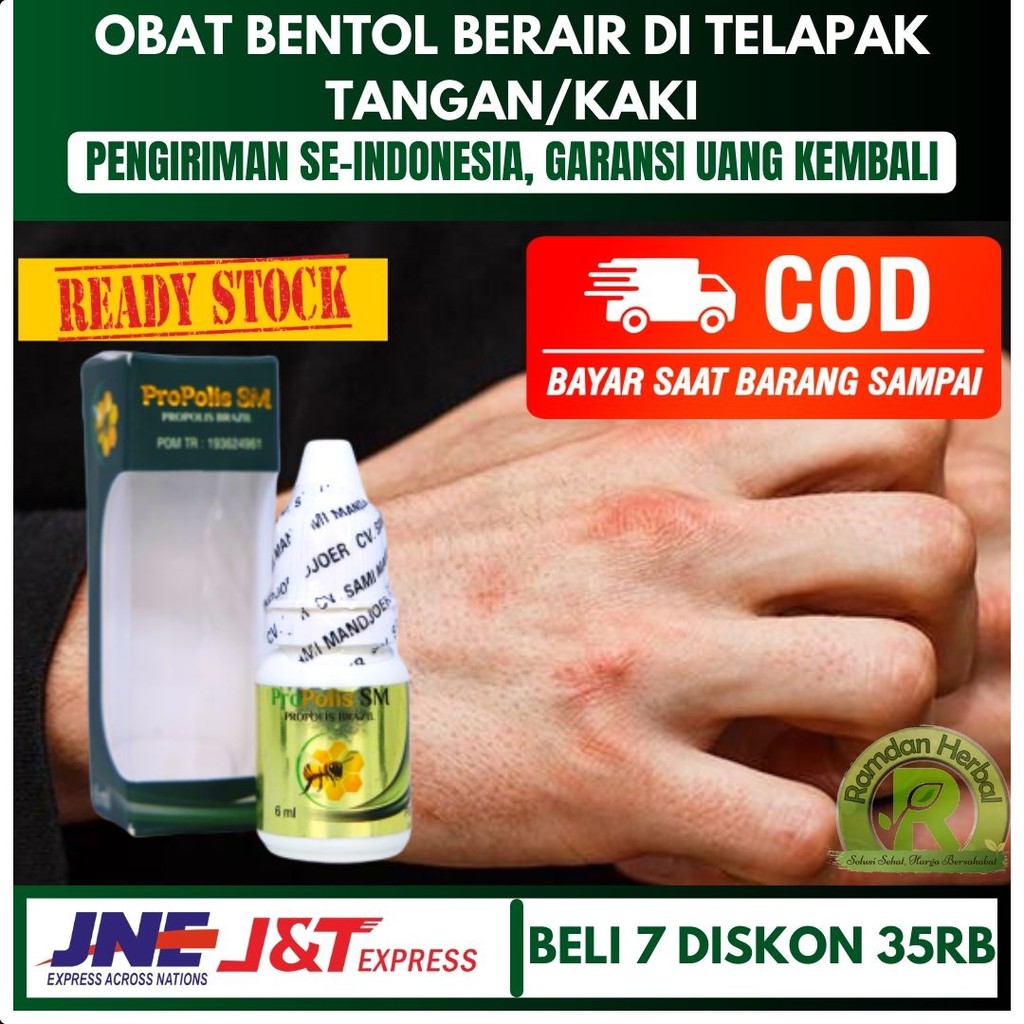 Obat Bentol Berair Ditelapak Tangan Bentol Berair Ditelapak Kaki Bentor Bernanah Gatal Propolis SM