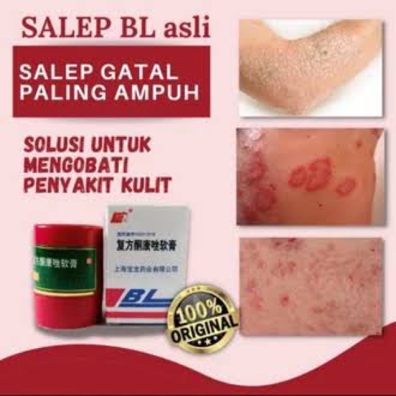 {Bisa kirim instant COD Medan Termurah}SALAP BL ASLI ORIGINAL 100% CREAM ASLI SALEP BL SALEP GATAL DIJAMIN TERBUKTI