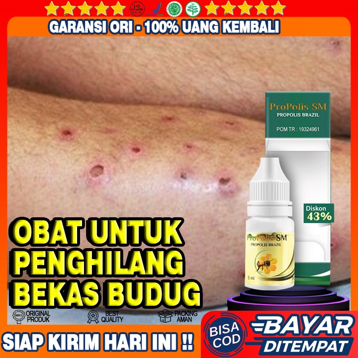 Obat Penghilang Bekas Budug, Budug Parah, Koreng Menahun, Penghilang Koreng, Budug, Budug Di Kaki