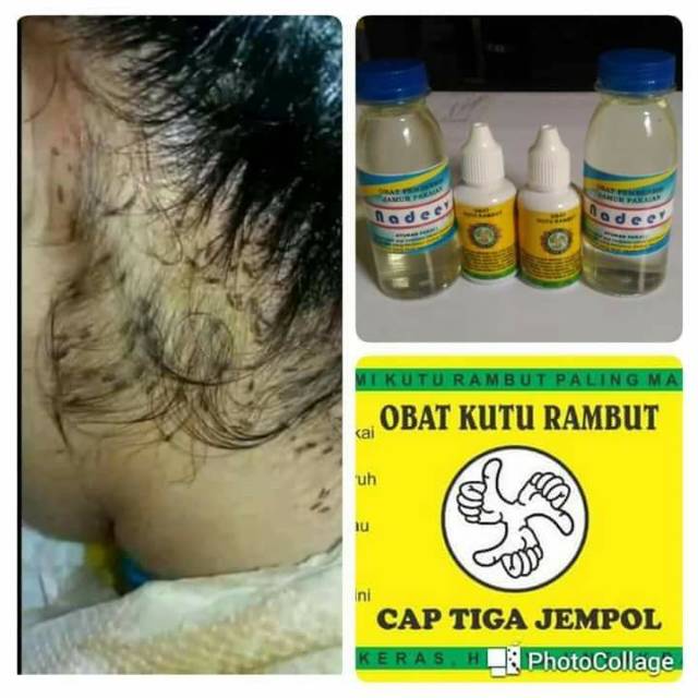 Cod Obat Herbal Kutu Rambut Ampuh Cuma 15menit Sudah Pada K O Shopee Indonesia