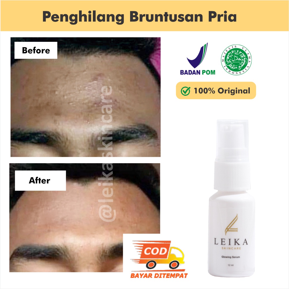 Serum Bruntusan Menghilangkan Bruntusan Di Wajah Serum Jerawat Dan Bruntusan Penghilang Bruntusan Pa