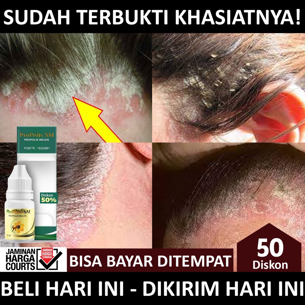 Jual OBAT KULIT KEPALA BERKERAK Propolis Sm Original Obat Psoriasis