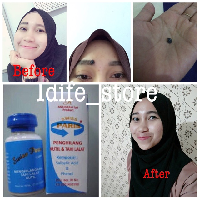 Swiss paris obat penghilang tahi lalat