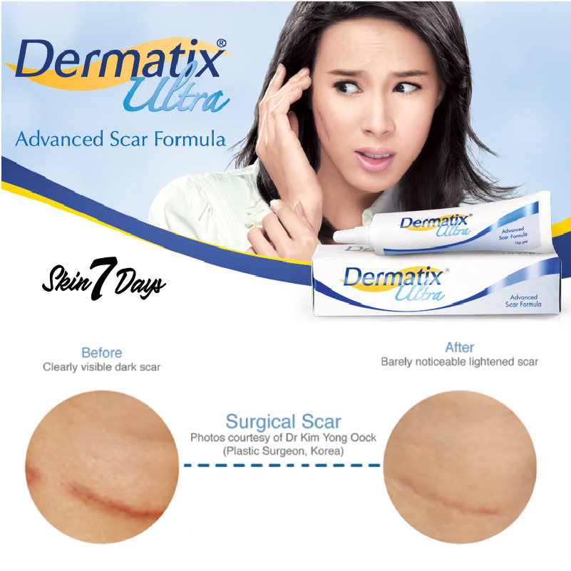 [ Dermatix Ultra ] Cream Penghilang Bekas Luka Operasi Iris Tergores Digigit Serangga Nyamuk / Luka Lama / Bakar / Gatal Hitam Koreng Di Kaki Oprasi Ampuh Advanced Scar Formula Gel Krim Wajah Keloid Stretchmark stretch mark Dermatik Dermatic Usa Original