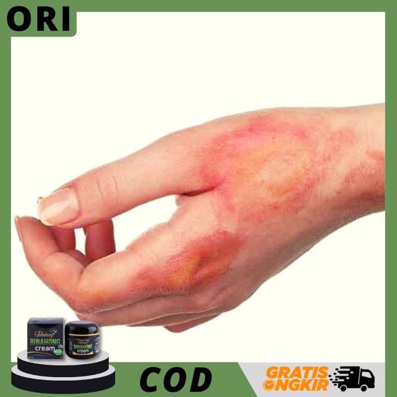 SALEP / KRIM OBAT LUKA BAKAR MELEPUH - SALEP KULIT TERBAKAR - SALEP KULIT MELEPUH - SALEP KULIT TERS