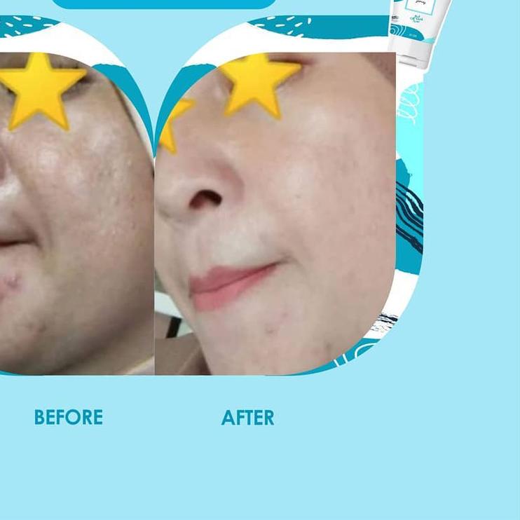 ➼ GLAFIDSYA SKIN ECERAN PAKET ACNE GLOWING GLAFIDSYA OFFICIAL STORE ➩