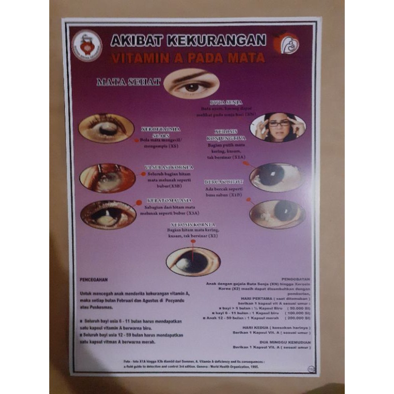 152 Poster Akibat Kekurangan Vitamin A Pada Mata Shopee Indonesia