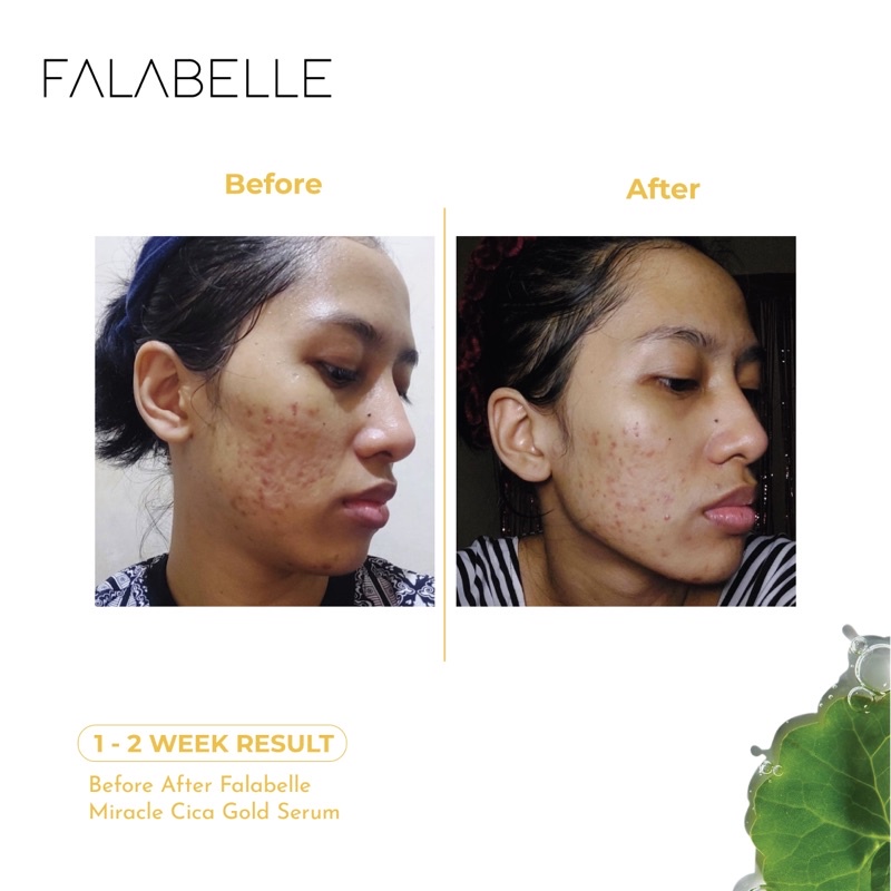 Serum Bekas Jerawat | Flek Hitam By Falabelle