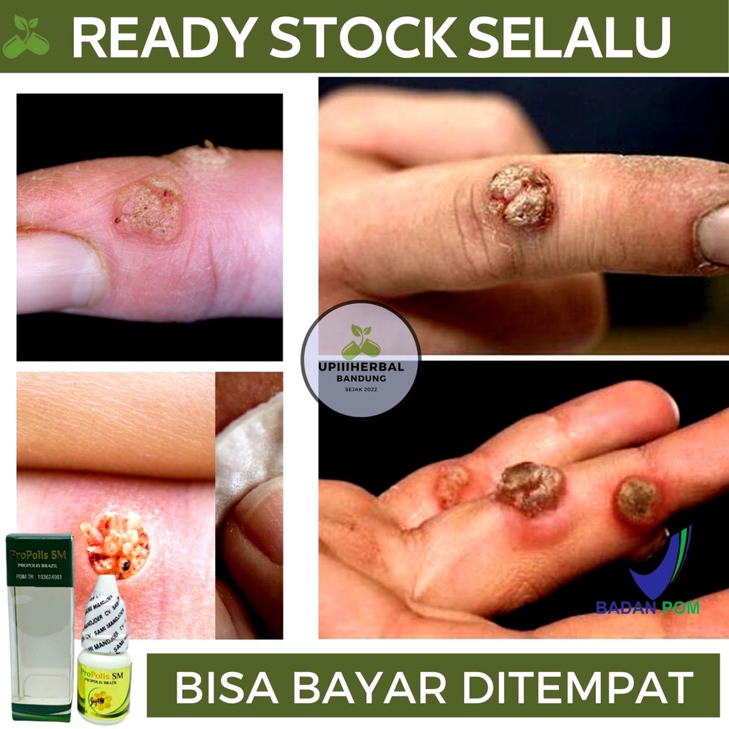 Obat Kutil Di Kulit, Obat Kutil Di Jari Tangan, Obat Kutil, Obat Perontok Kutil, Obat Pengempis Kuti