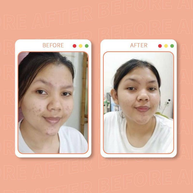 Paket Acne Package Vavl Beaute by Vivalentine free Pouch-5