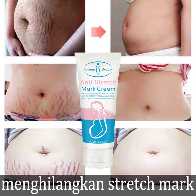 Anti Stretch Mark Cream AICHUN BEAUTY Stretch Mark Removal Bekas Luka Perbaikan Cream Stretch Mark Removal Perawatan Bekas Luka 60g body lotion, pelembab kulit, menghidrasi dan mengangkat