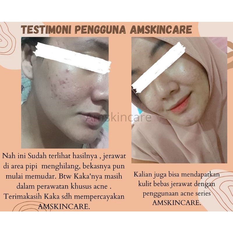 PAKET ACNE  BY AMSKINCARE | AMPUH USIR JERAWAT BANDEL