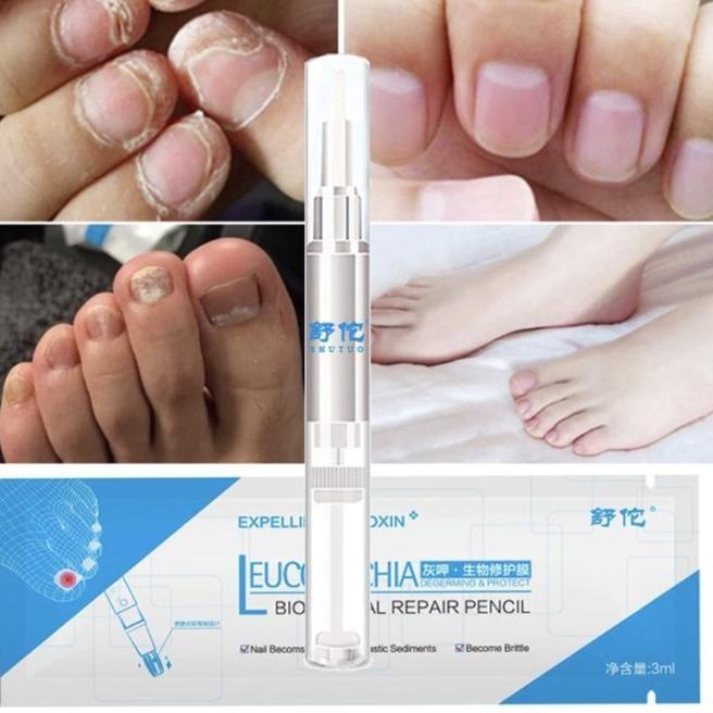Miny | Obat Jamur Kuku Leuconychia Cream Salep Cantengan Kuku Kaki Dan Tangan