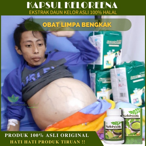 Obat Limpa Bengkak, Pembengkakan & Pembesaran Limpa, obat penyakit kuning, Perut Bengkak, Obat Pembe