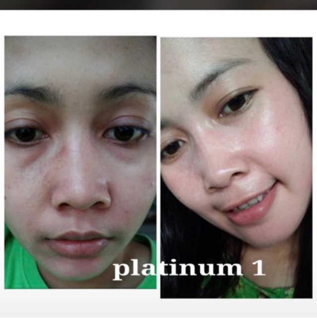 Lskin Platinum 1+  Paket Skin Care Perawatan Wajah Menghilangkan Jerawat Dan Pemutih Wajah-8
