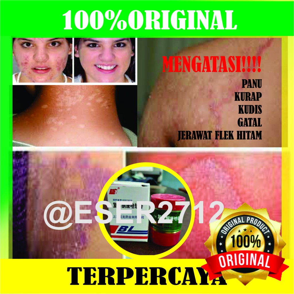 obat kulit/salep kulit/salep gatel/obat cina/obat kurap/penghilang jerawat flek hitam/panu //100%ori