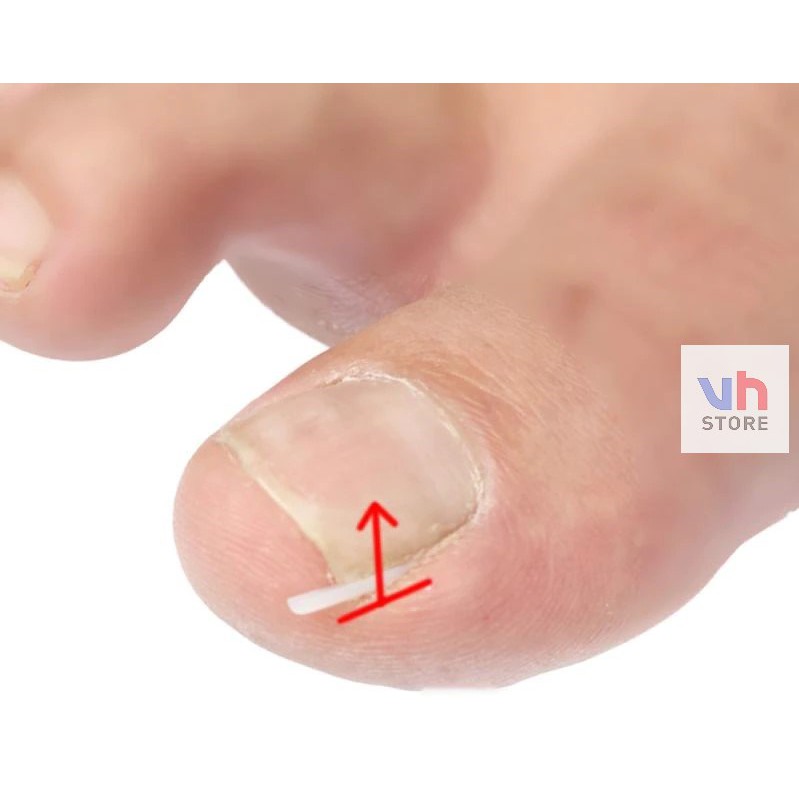 Bantalan Silikon Kuku Ingrown Nail Isolation Pad Mencegah Cantengan
