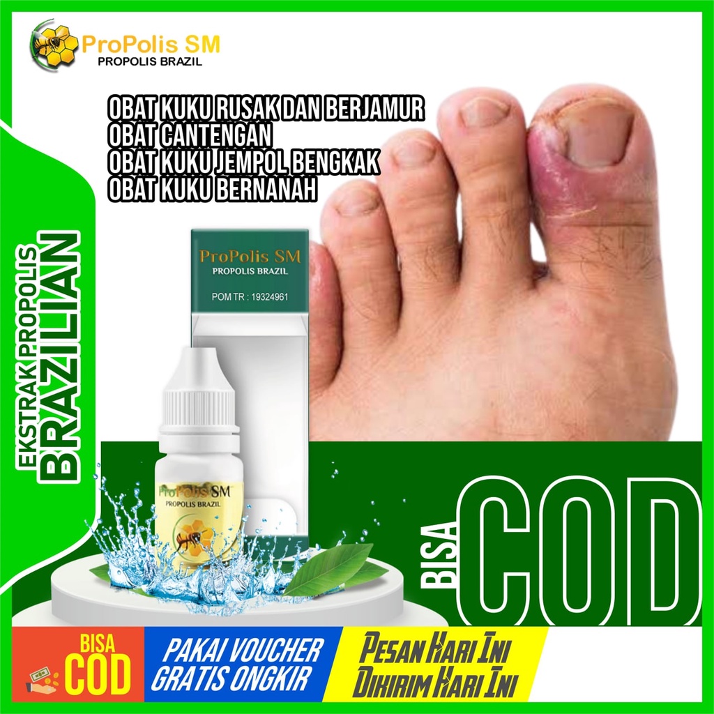 Obat Kukur Rusak dan Berjamur - Obat Cantengan - Obat Kuku Jempol Bengkak - Obat Kuku Bernanah - Pro