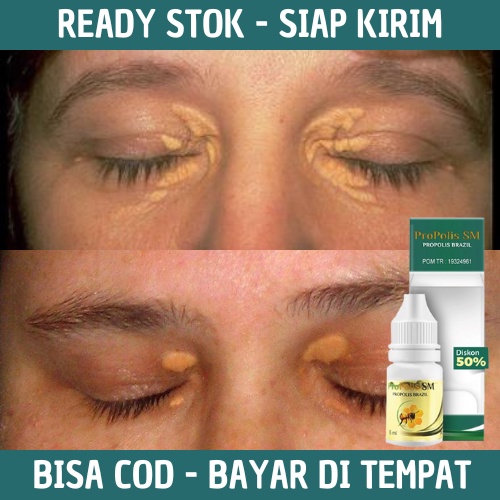 Obat Xanthelasma, Obat Untuk Menghilangkan Xanthelasma, Obat Xanthelasma Mata, Obat Penghilang Xanth