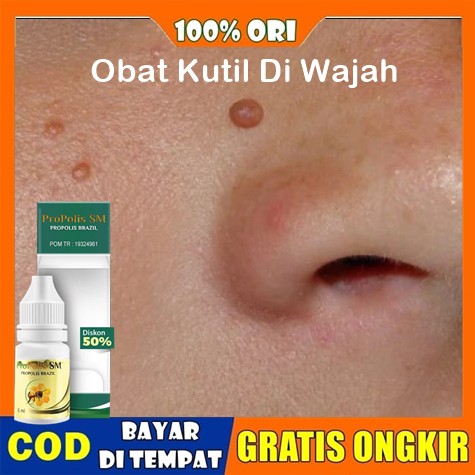 Obat Kutil Wajah, Obat Kutil Wajah dan Leher 100% Herbal Alami