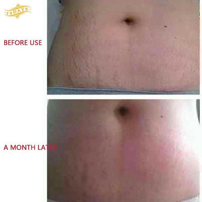 cream pemutih Penghilang Stretch Marks untuk Ibu Hamil