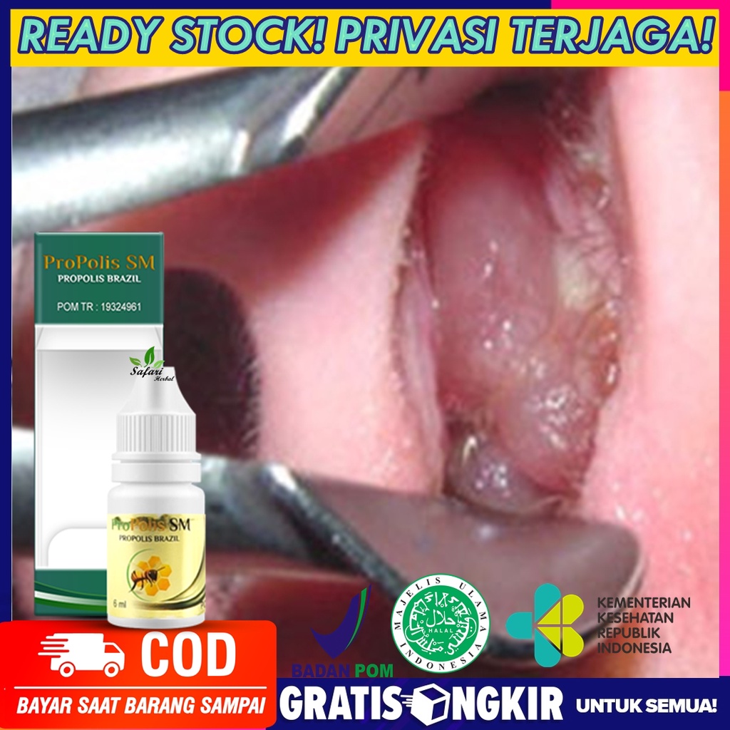 Obat Polip Hidung Sinusitis Gangguan Penciuman Sinusitis Propolis SM 100% Terbukti Testimoni - Propo