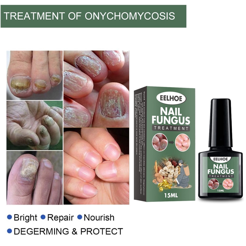 NAIL FUNGUS TREATMENT 15ML OBAT JAMUR KUKU BY EELHOE