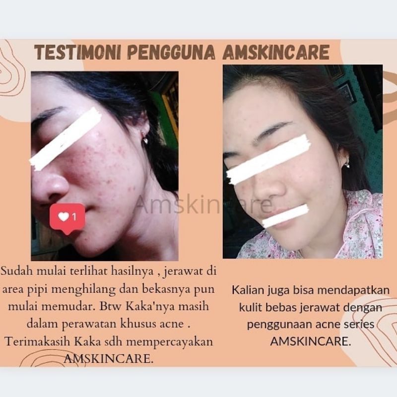 PAKET ACNE  BY AMSKINCARE | AMPUH USIR JERAWAT BANDEL