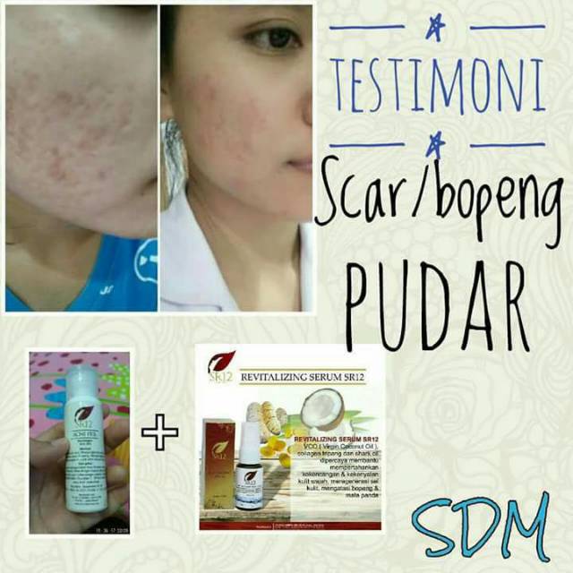 ACNE PEEL BHA30% / ATASI BOPENG / MENGANGKAT KOMEDO MENGURANGI BEKAS JERAWAT &amp; BRUNTUS