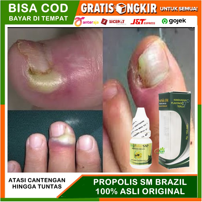 Obat Tetes Jempol Kuku Cantengan, Jamur Kuku, Penghilang Bau Kaki, Infeksi Kuku Kaki - Propolis SM