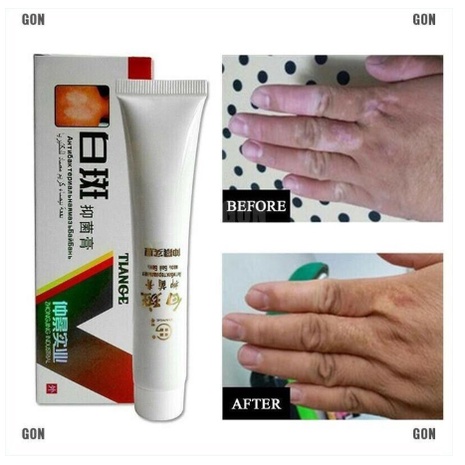 Obat Salep Vitiligo Salep Tiange Penghilang Bercah Putih 1000% Original