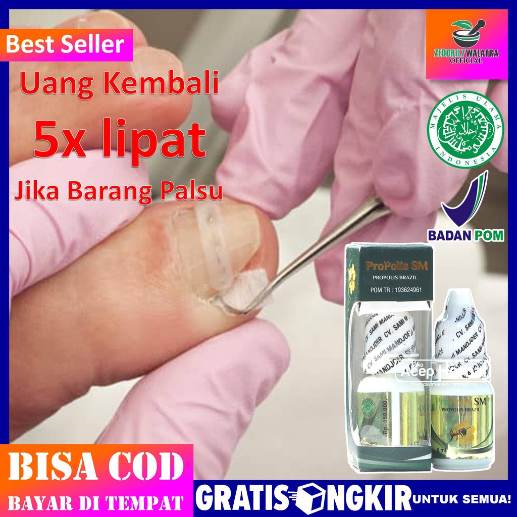 Obat Cantengan Di Kaki Dan Tangan Herbal Propolis Sm Brazil Paling Aman Ibu Jari Kaki Bernanah Cod Shopee Indonesia