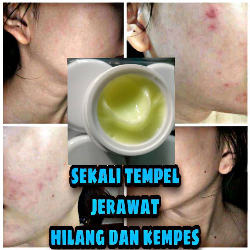 "Best seller produk" cream malam Acne glow diamond/acne glowing/acne super/cream malam jerawat parah