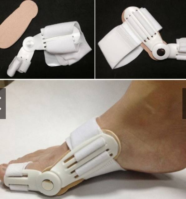 Bunion Hallux valgus Terapi Pelurus Jempol Kaki