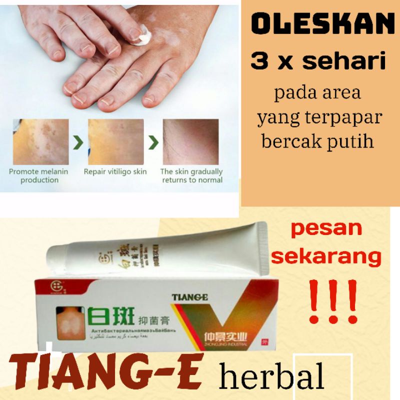 mengobati vitiligo kulit belang terpapar bercak putih