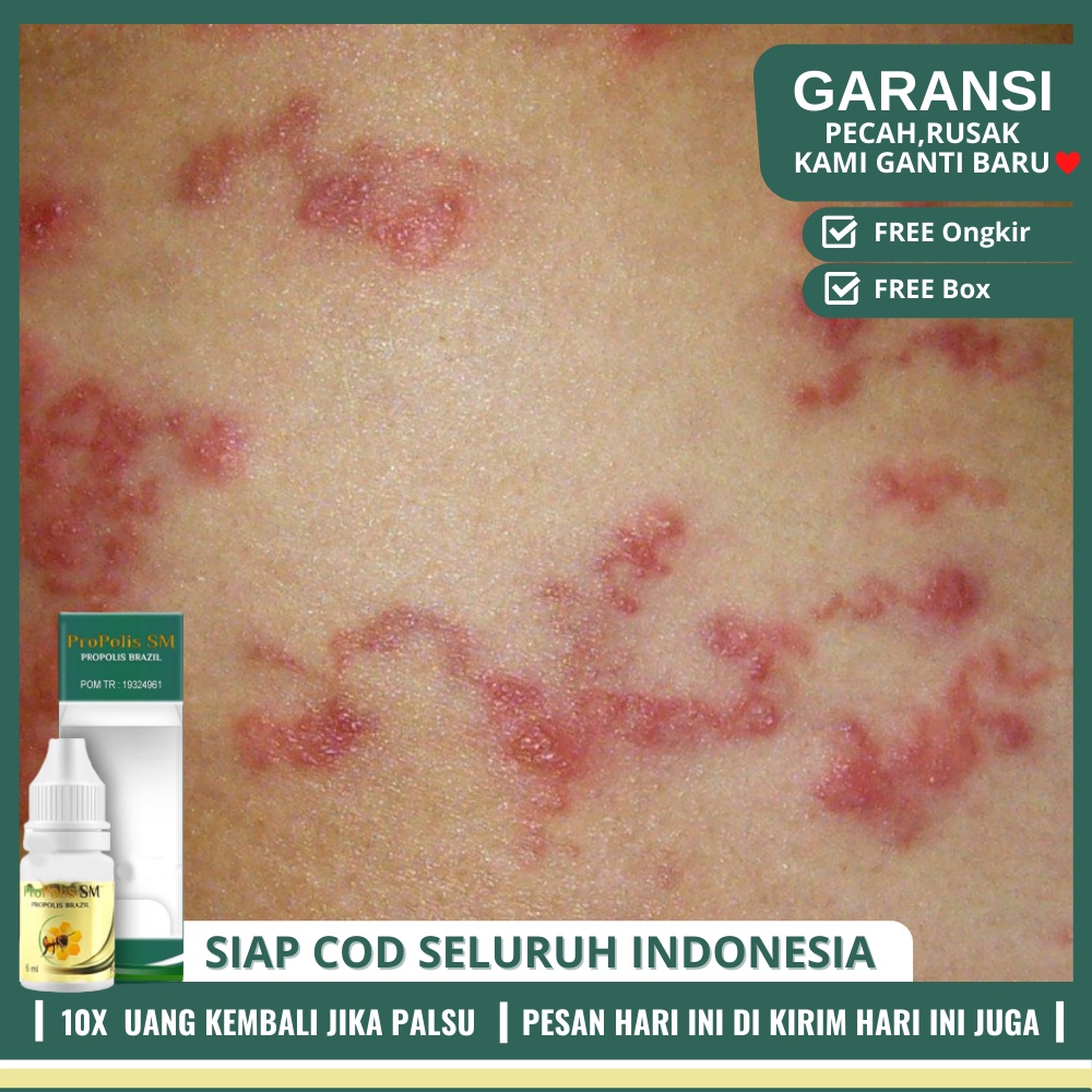 Obat Gatal Area Bokong, Jamur Kulit, Menghilangkan Gatal Di Pantat Dan Selangkangan Hitam - PROPOLIS