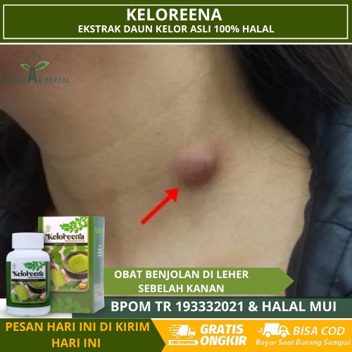 Obat Benjolan Di Leher Sebelah Kanan Dan Kiri, Kelenjar Tiroid, Kelenjar Tiroid Bengkak, Gondok Beng