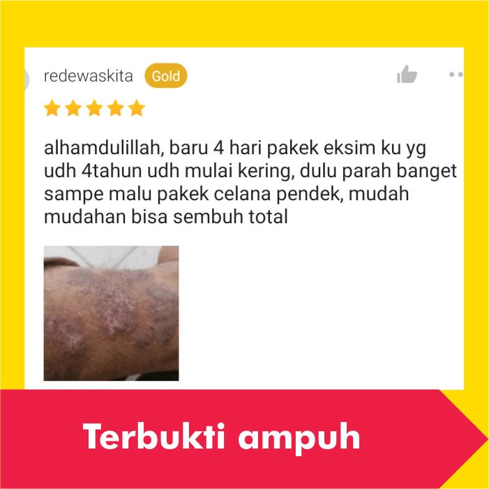 Salep Obat Gatal Eksim Kering Menahun Paling Ampuh Kulit Gatel Exim Basah Saleb Selangkangan Kurap Kutu Air Luka Diabetes Panu Kudis Kadas-1