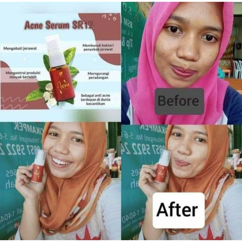 SERUM JERAWAT BPOM AMPUH..!! ACNE SERUM SR12 / OBAT PENGHILANG JERAWAT / SERUM RADANG JERAWAT