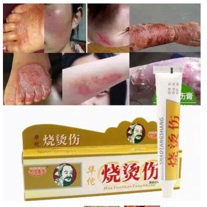 Obat Salep Luka Bakar Air Panas Melepuh HuaTuo herbal shaotang cina