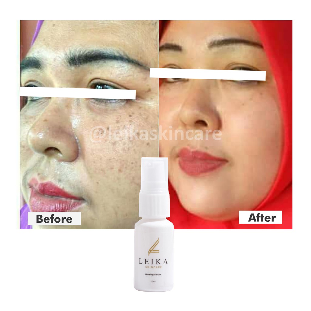 Serum Penghilang Bintik Hitam Di Wajah Bpom Penghilang Bintik Hitam Di Wajah Serum Penghilang Flek H