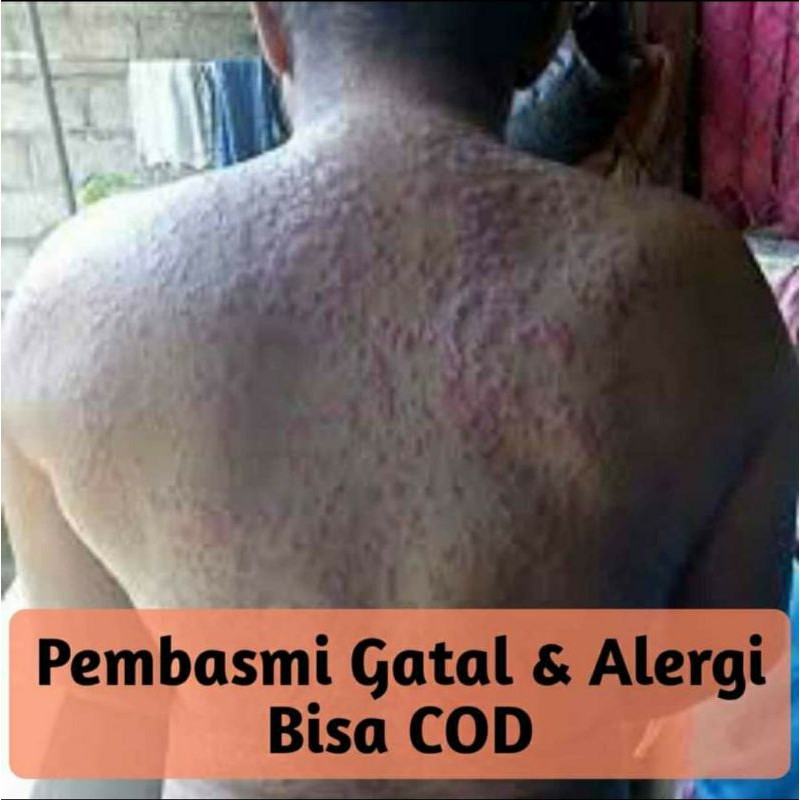 Pembasmi Gatal dan Alergi
