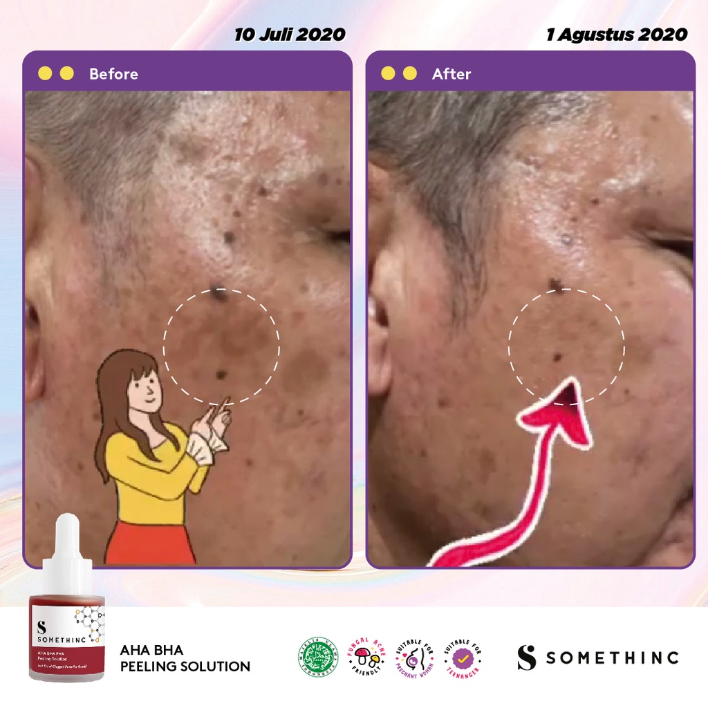 ⭐ BAGUS ⭐ SOMETHINC AHA BHA PEELING SOLUTION 20ml | Pori-Pori Tersumbat Komedo Bekas Jerawat