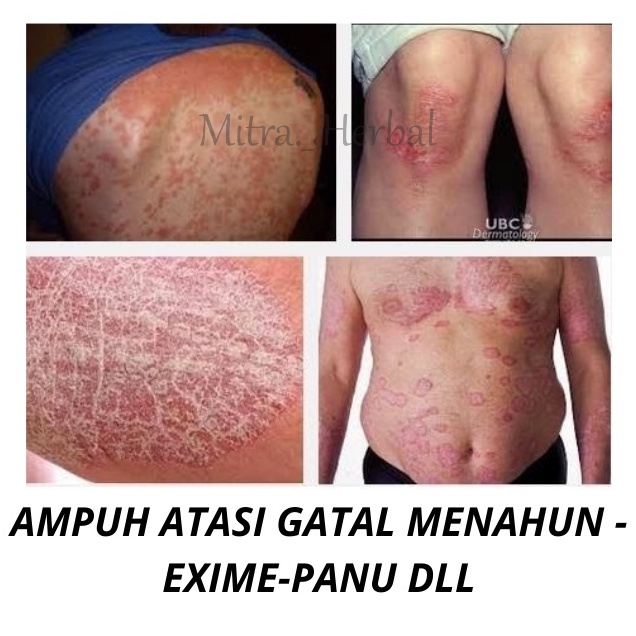 Brotowali Kapsul Obat Gatal / Alergi Biduran / Herbal Daun Jamu / Suplemen Kesehatan Isi 50 Kapsul