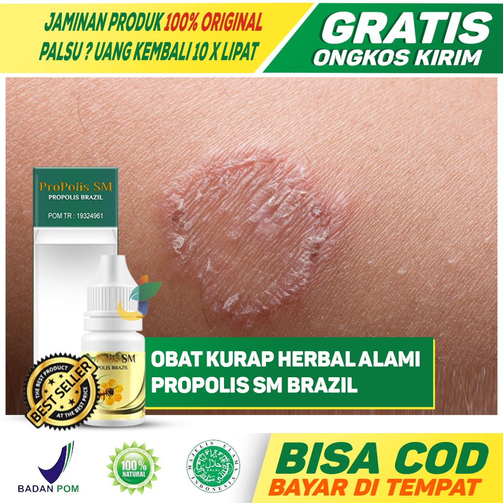 Obat Kurap Propolis Bisa UntukKulit Gatal Menahun Panu Kadas Kurap Kutu Air di Tangan Ketiak Lipatan