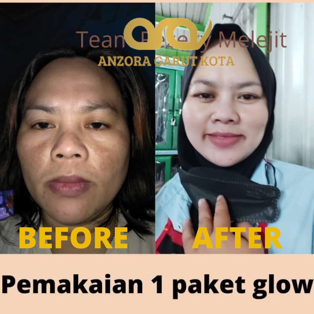 ANZORA ANZORA SKINCARE ANZORA SKINCARE GLOWING ANZORA ACNE ANZORA ACNE DARK SPORT ANZORA SKINCARE ORIGINAL SKINCARE ACNE SKINCARE KECANTIKAN PERAWATAN WAJAH PERAWATAN WAJAH ANZORA BODY LOTION SKINCARE GLOWING SKINCARE WAJAH BERJERAWAT  ANZORA GARUT KOTA-3