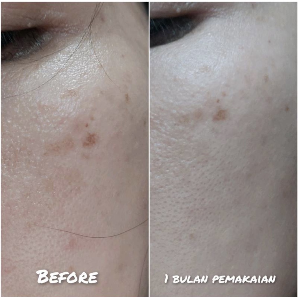 Paket Mencerahkan | LUNICA Bright Bloom Package | Treatment Flek, Melasma, Bekas Jerawat