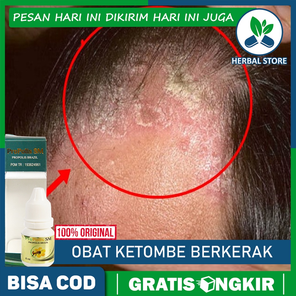 Jual Obat Ketombe Berkerak - Kulit Kepala Kering - Psoriasis Kulit